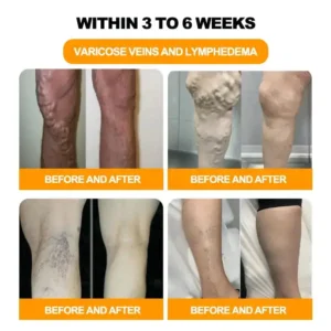 𝐁𝐞𝐞 𝐕𝐞𝐧𝐨𝐦 & 𝟑𝟎-𝐇𝐞𝐫𝐛 𝐃𝐞𝐭𝐨𝐱 𝐅𝐨𝐨𝐭 𝐒𝐨𝐚𝐤 𝐁𝐞𝐚𝐝𝐬 𝐟𝐨𝐫 𝐁𝐨𝐝𝐲 𝐒𝐜𝐮𝐥𝐩𝐭𝐢𝐧𝐠 - Image 3
