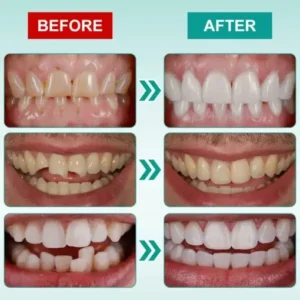 𝗜𝗻𝘀𝘁𝗮𝗻𝘁 𝗦𝘁𝗶𝗰𝗸-𝗼𝗻 𝗗𝗲𝗻𝘁𝗮𝗹 𝗩𝗲𝗻𝗲𝗲𝗿𝘀 - Image 7