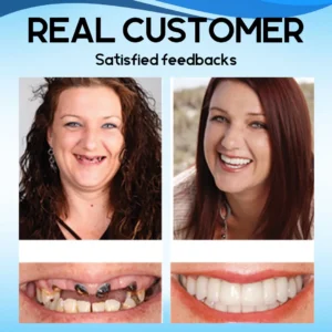 SnapOn Silicone Veneers - Image 5