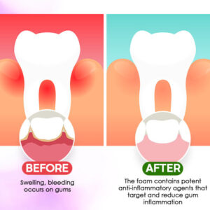 Gum Treatment Foam - Image 4
