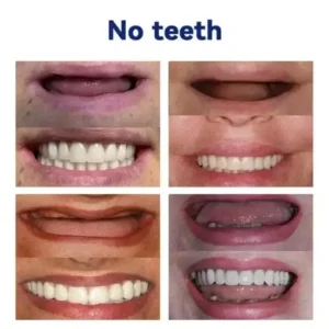 Advanced Customized Full Denture Set