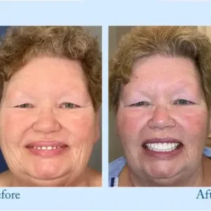 Advanced Customized Full Denture Set - Image 5