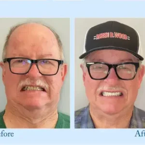 Advanced Customized Full Denture Set - Image 8