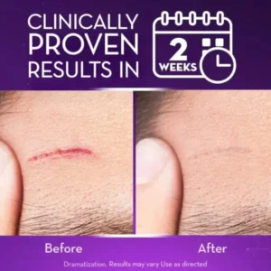 Advanced Scar Gel