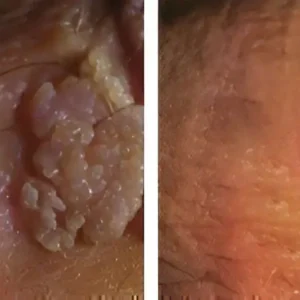|Genital Warts Remover Cream for Men - Image 21