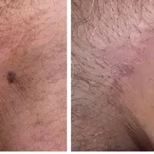 |Genital Warts Remover Cream for Men - Image 25