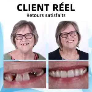 Silicone Reline Denture Set - Image 4