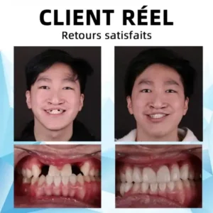 Silicone Reline Denture Set - Image 5