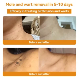 Bee Venom Wart & Moles Removal Cream - Image 4