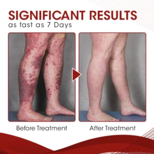 DermaCure Psoriasis Treatment Spray - Image 5