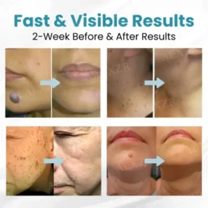 Non-Invasive Mole and Wart Removal Laser Pen - Image 2