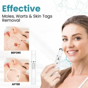 Non-Invasive Mole and Wart Removal Laser Pen - Image 5