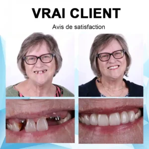 Silicone Reline Denture Set - Image 6
