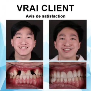 Silicone Reline Denture Set - Image 8