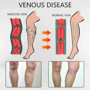 Varicose Veins Relief Oil - Image 3