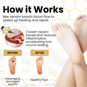 Bee Venom Diabetic Foot Ulcer Spray - Image 4
