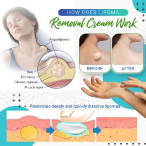 Cvreoz Lipoma Removal Cream - Image 4