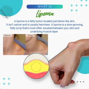 Cvreoz Lipoma Removal Cream - Image 6