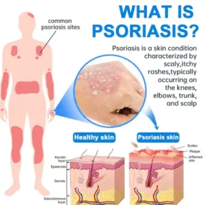 Magnesium Herbal Psoriasis Spray - Image 7