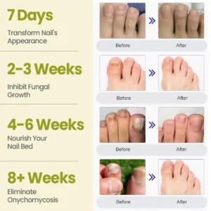 Nail Fungal Patches Pro+ - Image 6
