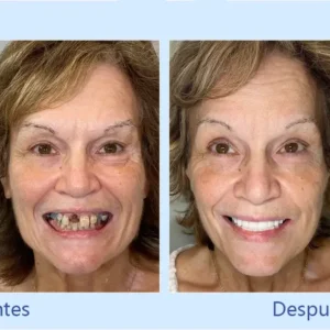 - Prótesis Dental Premium - Image 11