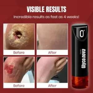 Dafeila® Glyconova Blood Sugar Inhaler - Image 2