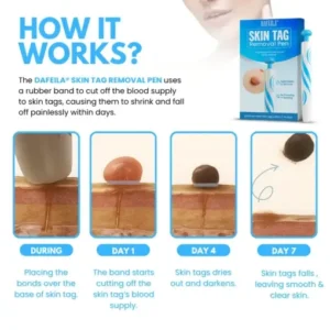 Skin Tag Removal Pen - Image 4