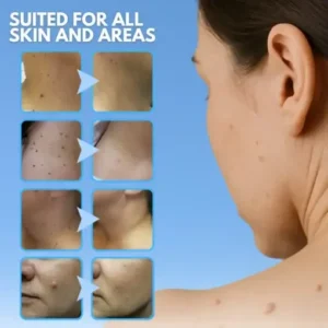 Skin Tag Removal Pen - Image 5