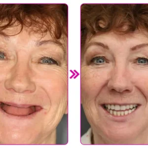 Thermoplastic Denture Adhesive - Image 7