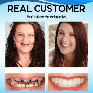 Silicone Reline Denture Set - Image 4