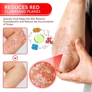 Multi-Symptom Bee Venom Psoriasis Treatment Spray - Image 5