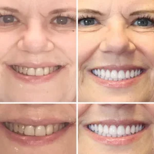 Advanced Customized Full Denture Set - Image 6
