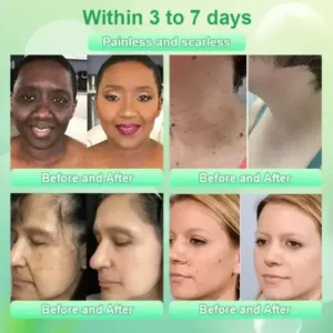 Purifying Exfoliating Gel for Acanthosis Nigricans - Image 3