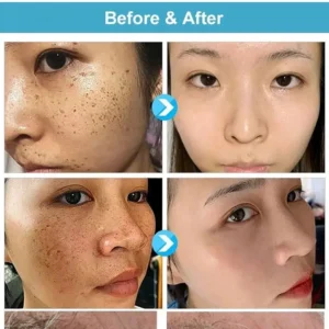 Concentrated potent skin tag removal cream - Image 2