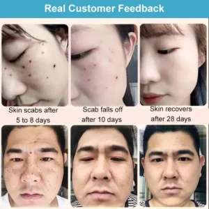 Concentrated potent skin tag removal cream - Image 5