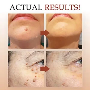 Concentrated potent skin tag removal cream - Image 6