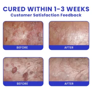 Genital Warts Remover Cream - Image 9