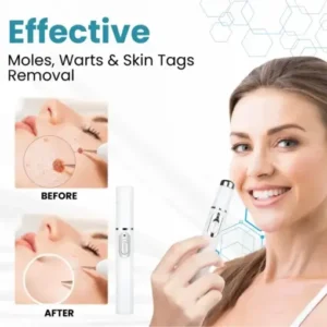 Non-Invasive Mole and Wart Removal Laser Pen - Image 5