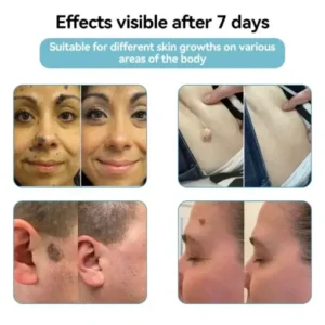 VelvetSkin+ All-in-One Laser Eraser Pen - Image 2