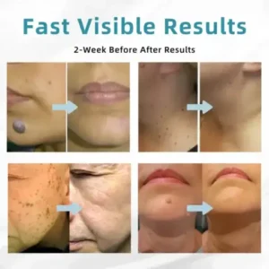 VelvetSkin+ All-in-One Laser Eraser Pen - Image 5