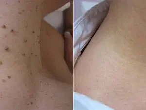 Bee Venom Mole and Wart Treatment Cream - Image 8