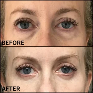 Eye Roller for Puffiness - Image 4