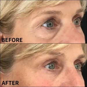 Eye Roller for Puffiness - Image 5