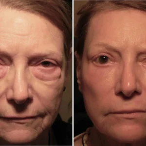 Eye Roller for Puffiness - Image 11