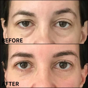 Eye Roller for Puffiness - Image 6