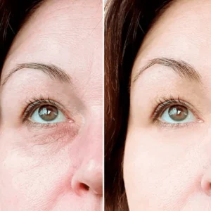 Eye Roller for Puffiness - Image 8