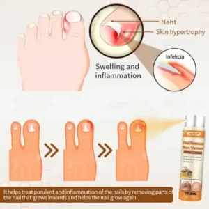 NailRescue Včelí jed ve spreji - Image 4