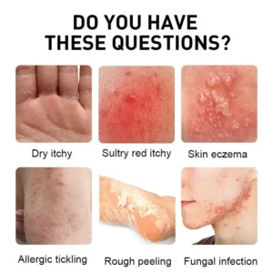 Psoriasis Cure Cream - Image 2