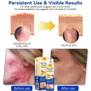 PsoriaHeal psoriasis Spray - Image 3