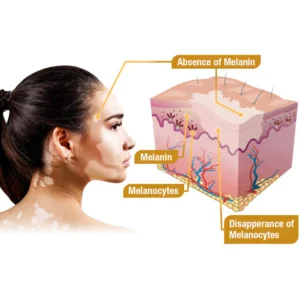 BeeVenom Vitiligo Treatment Cream - Image 5